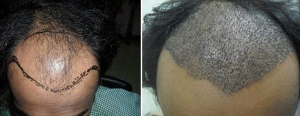 Baldness, Baldness treatment, Hair Replacement, Hair Weaving, Microwefting,  Bonding Ludhiana