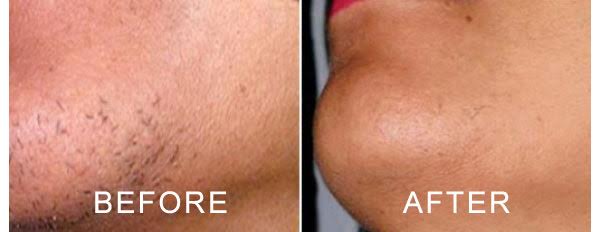Laser Treatment For Chin Hair Removal Cheap Sale, 57% OFF |  